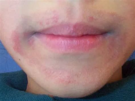 Eczema Around The Mouth And Lips Your Guide Myeczemateam