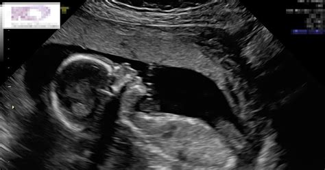 Unborn Baby Gives Mum A High Five In Incredible Image