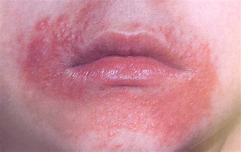 Dermatitis Herpetiformis Face Photos Glutenfreegal