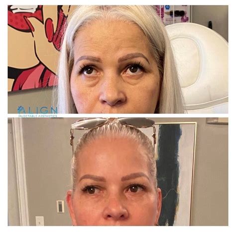AGNES RF RADIOFREQUENCY TO MELT UNDEREYE BAGS Align Injectable Aesthetics