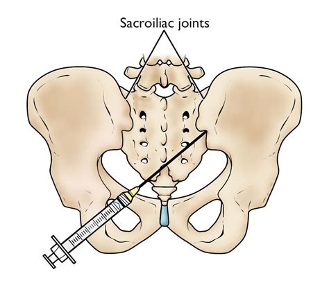 Spinal Injections As A Minimally Invasive Option For Neck And Back Pains Rela Hospital