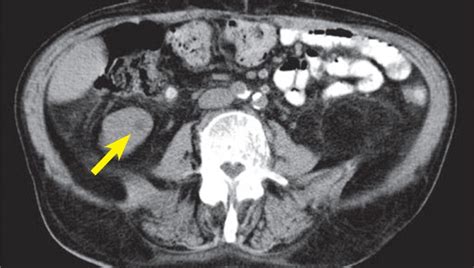 Abdominal Ct Scan Shows Small Primary Renal Tumor In The The Right