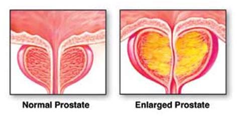 If You Suffer From Prostate Enlargement Here S What You Need To Know Prostate Health Tips