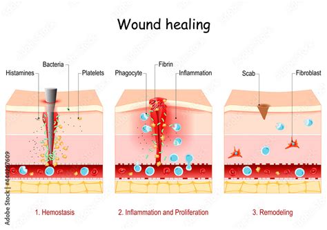 Wound Healing Stages Of The Post Trauma Repairing Process Stock Vector