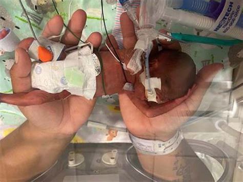 Record Breaking Premature Baby Celebrated At Alabama Hospital