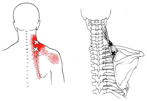 Levator Scapulae The Trigger Point And Referred Pain Guide