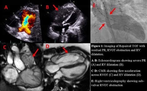 Right Ventricular Outflow Tract Obstruction In An Adult With Repaired