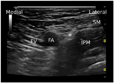 Short Axis Ultrasound View Of The Femoral Nerve At The Femoral Triangle