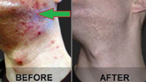 How To Get Rid Of Folliculitis At Home In 5 Day Guaranteed Result