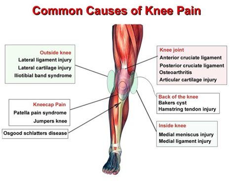 Medial Knee Pain Is Very Common Due Neurokinetic Therapy