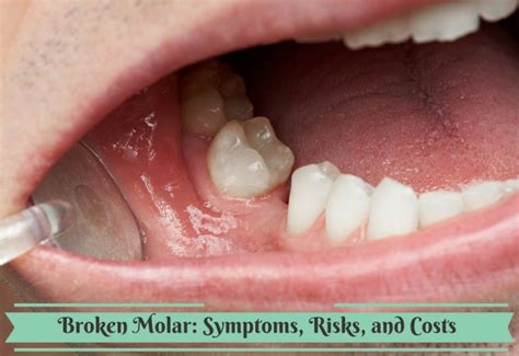 Broken Molar Symptoms Risks And Costs