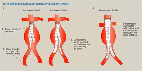 Anaesthesia For Elective Interventional Vascular Radiology