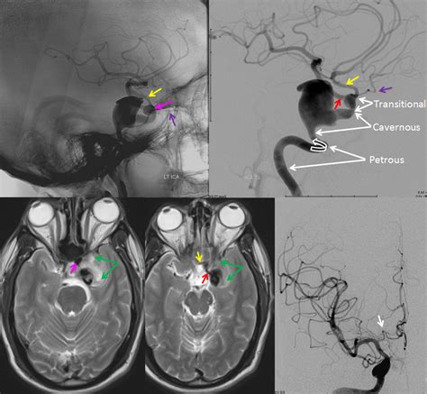 Internal Carotid Artery And Its Aneurysms Internal