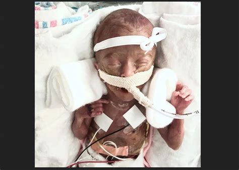 Incredible Photo Of Premature Baby Born At 22 Weeks Shows
