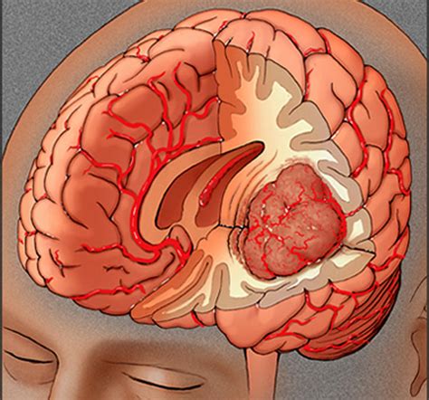 Loss of interest in sex; Know About The Causes And Symptoms Or Brain Tumor