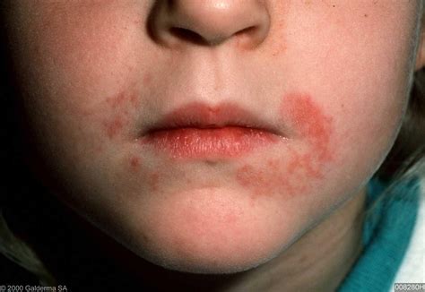 Dermatitis Rash On Face