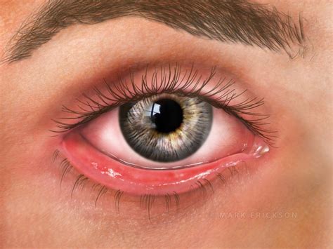 Ectropion Outward Turning Of The Eyelid Patient Education