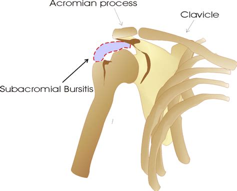 X Ray Subacromial Bursitis