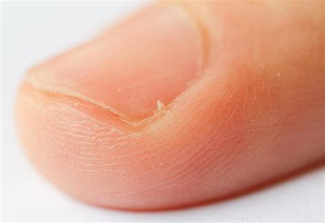 What Are The Common Causes Of Pus In The Finger