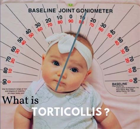 Pediatric Therapy For Torticollis Lake Forest Il The Baby Movement
