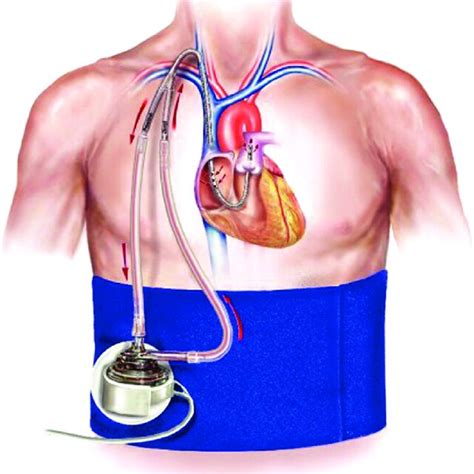 Impella Rp Catheter Courtesy Of Abiomed Download Scientific Diagram