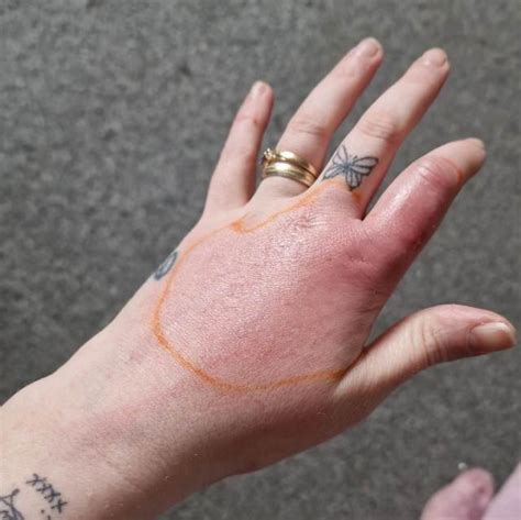‘spot On Womans Finger Turned Out To Be False Widow Spider Bite