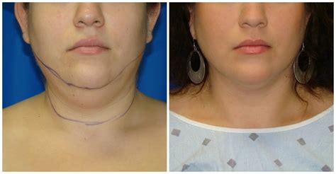 Chin Liposuction Houston Lipo Center