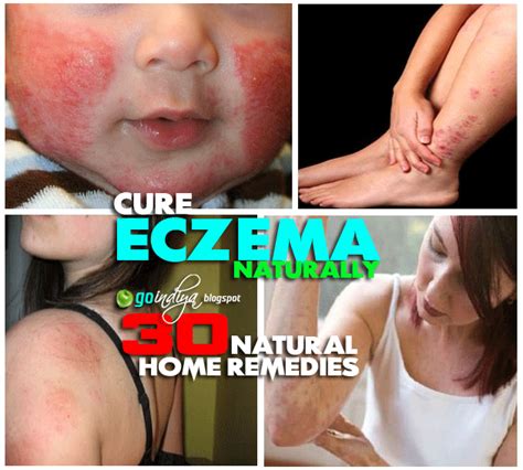 30 Best Home Remedies For Eczema Atopic Dermatitis In Kids And Adults