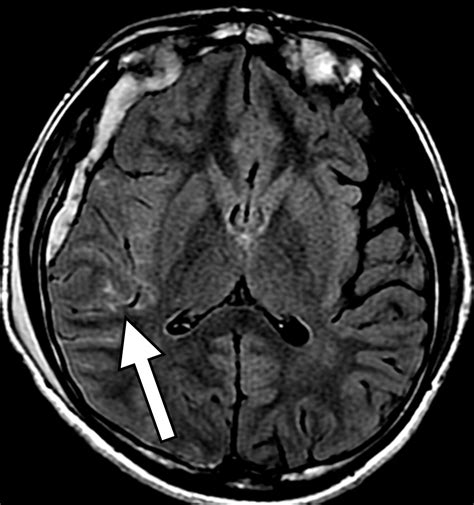 Traumatic Brain Injury Imaging Patterns And Complications Radiographics