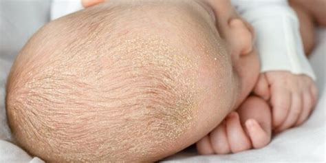 Dermatite Atopica Nel Neonato Cause Sintomi E Rimedi Gravidanzaonline