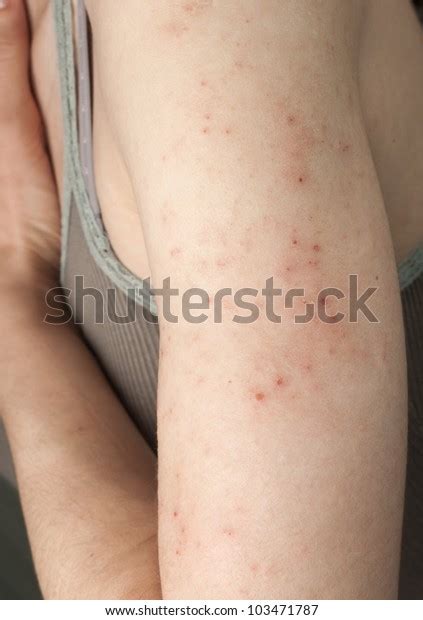 Allergic Rash Dermatitis Back Skin Patient Stock Photo Edit Now 103471787
