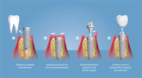 Dental Implants Oshkosh Implant Dentistry Govani Dental