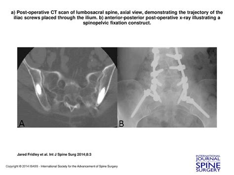 A Post Operative Ct Scan Of Lumbosacral Spine Axial View