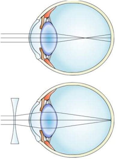 Materi Lengkap Alat Optik Mata Cacat Mata Dan Rumusnya Tips And Trik 1