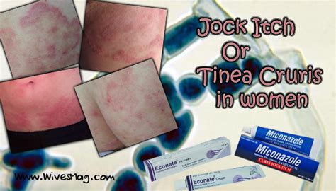 Jock Itch Or Tinea Cruris In Women Causes And Treatment Wivesmag