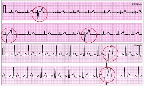 Recognizing Ecg Irregularities Blog