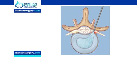 During the microdiscectomy procedure, the surgeon will create a slight incision in the patient's back, and while. herniated disc surgery recovery time | herniated disc surgery cost