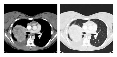 Contrast Enhanced Computed Tomography Revealed Pleural Infiltration On