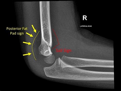 Supracondylar Fracture With Posterior Fat Pad And Sail Signs