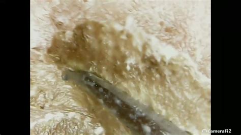 Peeling Dry Scab Youtube