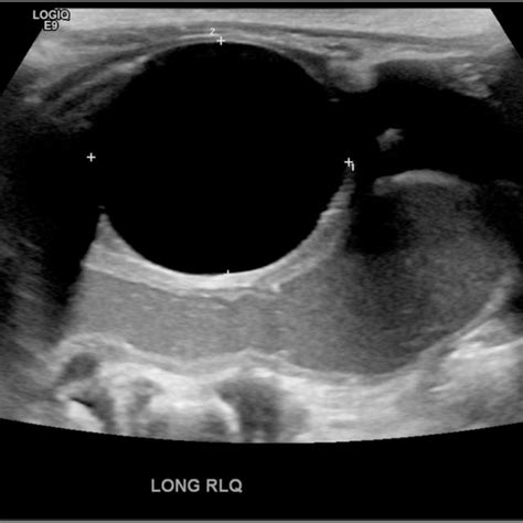 Pdf Orbeez Ingestion Can Mimic Duplication Cysts As A Cause Of