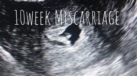 Miscarriage By Week