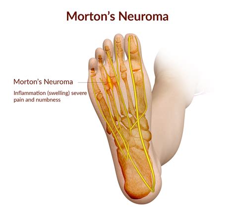 What Is Mortons Neuroma — South West Foot Surgery