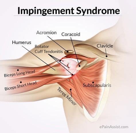 Rotator Cuff Shoulder Pain Diagnosis Chart