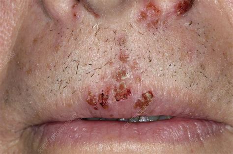 Cold Sores On The Upper Lip Stock Image C0051937 Science Photo