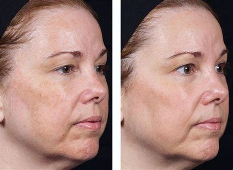 Laser Treatment For Broken Capillaries On Face Before And After
