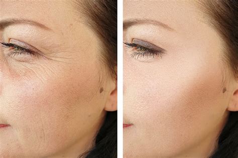 The Best Wrinkle Fillers On The Market And How Long They Last