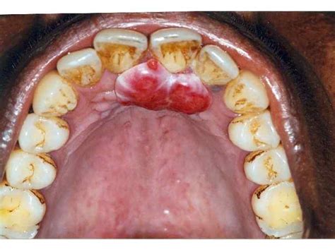 Oral Pyogenic Granuloma Intelligent Dental