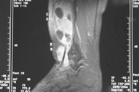 Synovial Sarcoma Soft Tissue Sarcoma