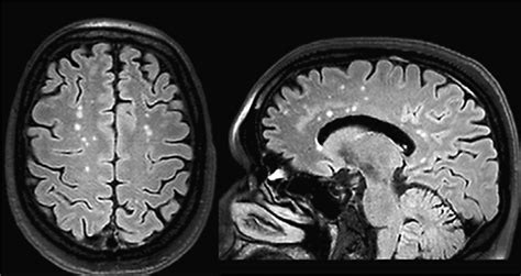 Brain Mri Showing Multiple T2 And T2flair Hyperintense Lesions Of The